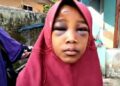 Bocah SD di Lebak Diduga Dianiaya Ayah Tiri Hingga Luka Memar