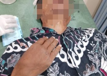SALAMUN UMUR 45 TAHUN MENGALAMI PATAH GIGI DAN MEMAR SELURUH BADAN DIDUGA DIANIYAYA TETANGGA INISIAL (MS)
